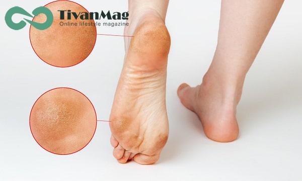 عوامل ژنتیکی در ایجاد پینه پا